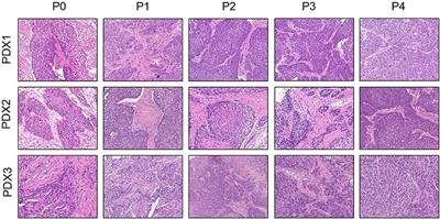 Corrigendum: Anlotinib Combined With Chemoradiotherapy Exhibits Significant Therapeutic Efficacy in Esophageal Squamous Cell Carcinoma